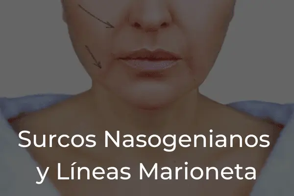 Surcos Nasales y Comisuras Bucales