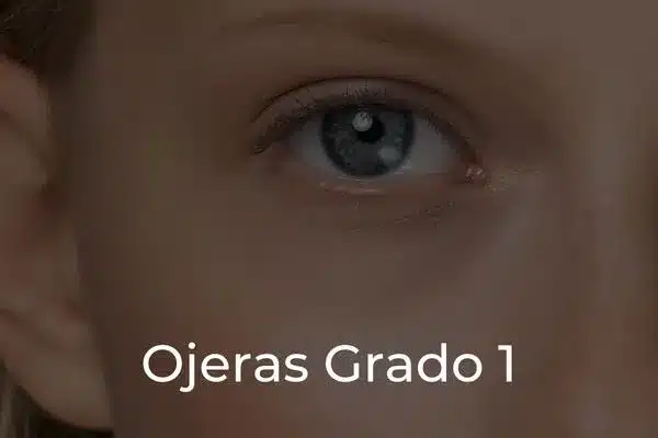 Tratamiento Ojeras Grado 1_portada