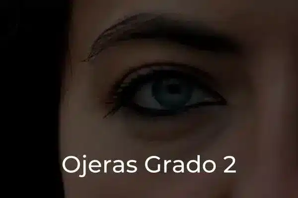 Tratamiento Ojeras Grado 2_portada
