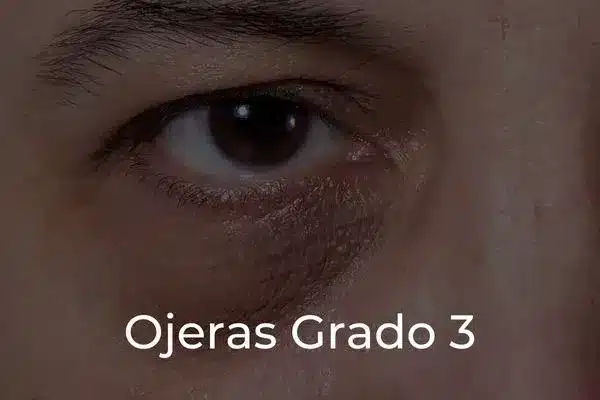 Tratamiento Ojeras Grado 3_portada